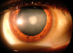 Cataract In Human Eye