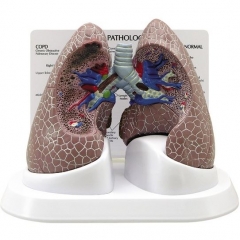 Diseased Lung Model