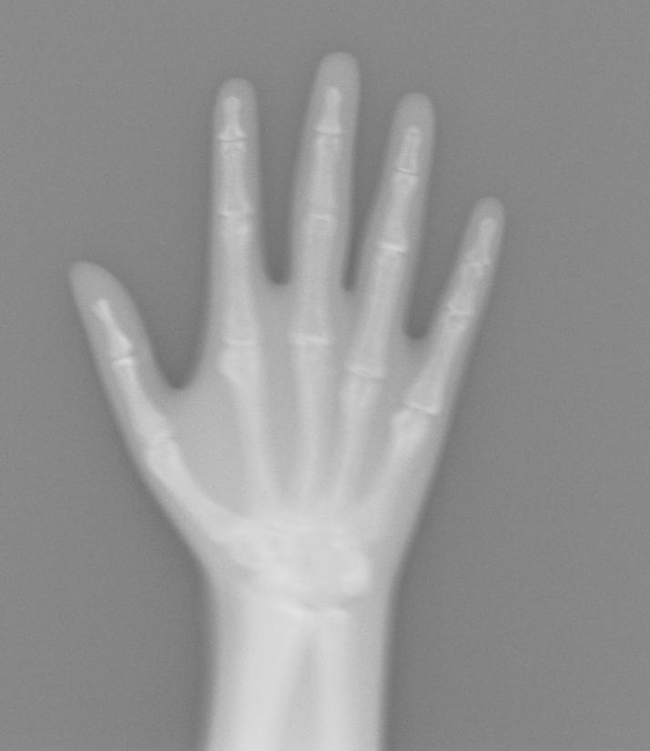 Hand X-Ray via Lumbar Spine Phantom