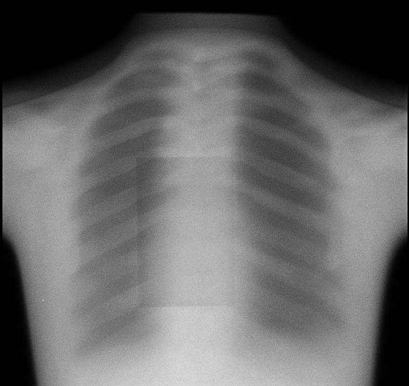 Chest X-Ray via Lateral Lumbar Spine Phantom