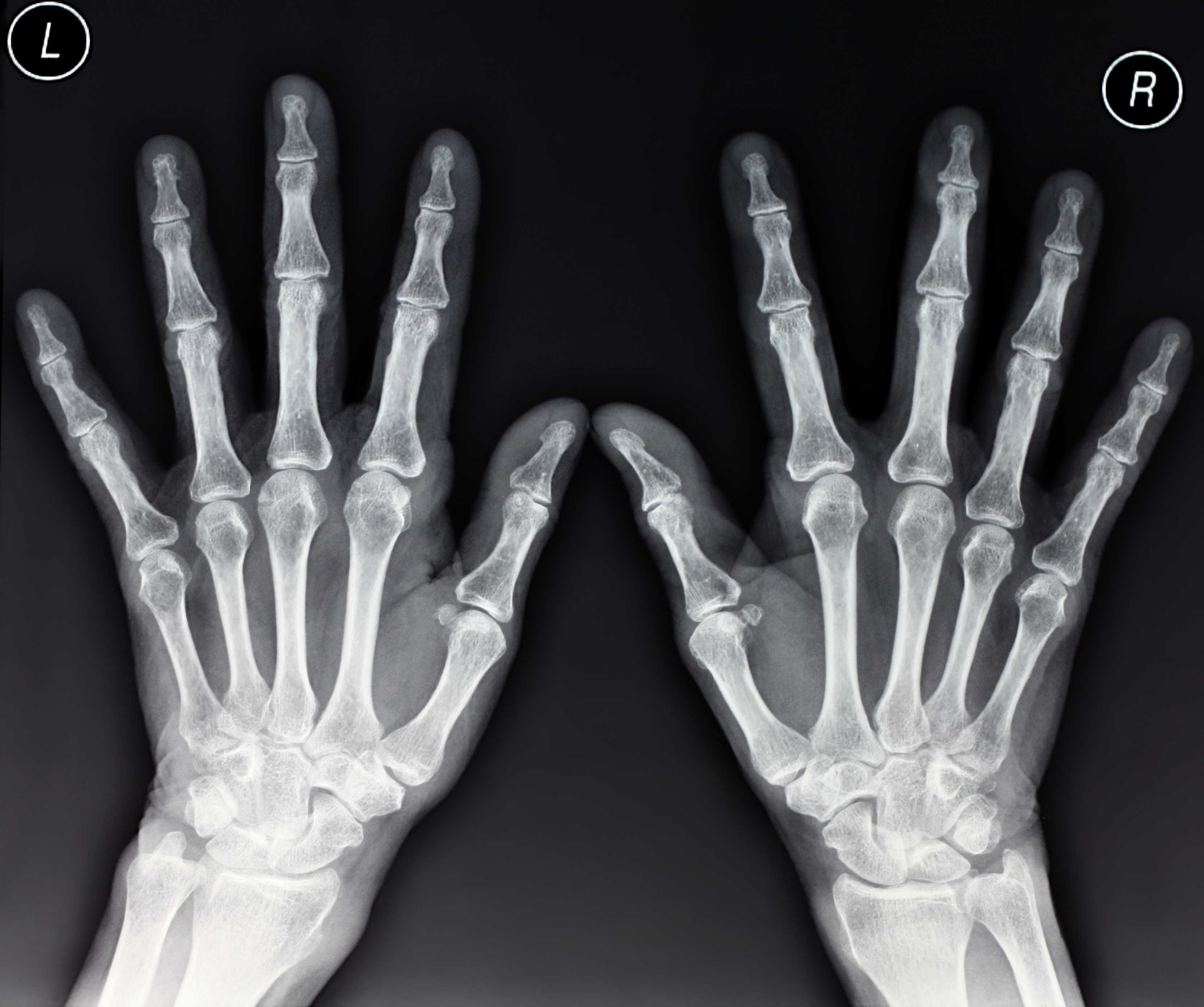 when to get a hand x ray