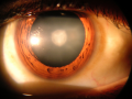 Cataract In Human Eye