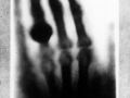 Bertha's Hand with Wedding Ring