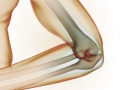 Stabilizing Upper Extremities