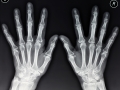 Hands X-ray