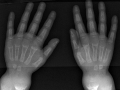Hand X-Ray with Markers