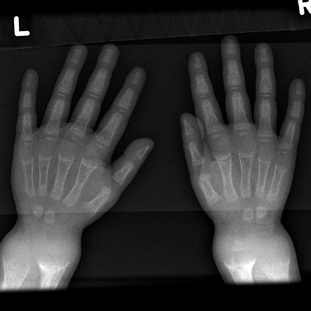 Hand X-Ray with Markers